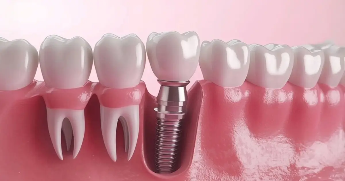 Surgical Implant Placement in Michigan 