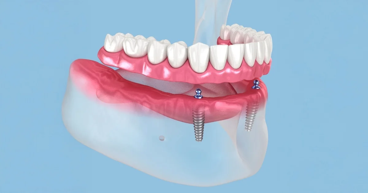 Best Dental Implants in Detroit, MI