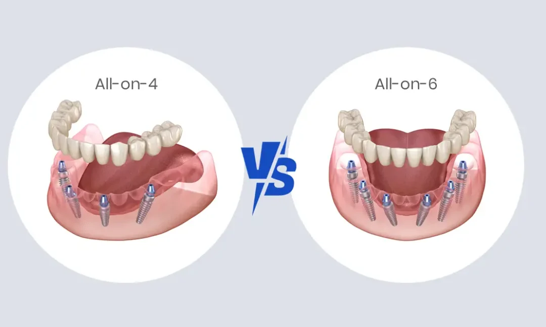 All-on-4 vs All-on-6 Implants: Which One Is Better for You in Michigan?