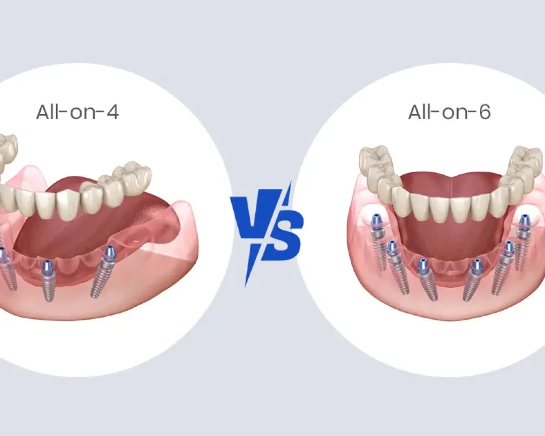 All-on-4 vs All-on-6 Implants: Which One Is Better for You in Michigan?