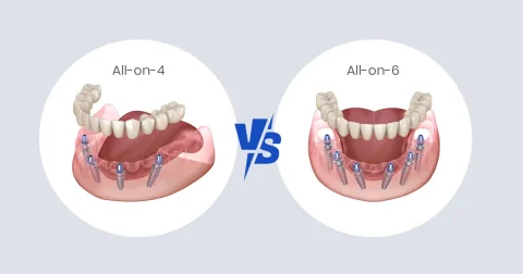 All-on-4 vs All-on-6 Implants: Which One Is Better for You in Michigan?