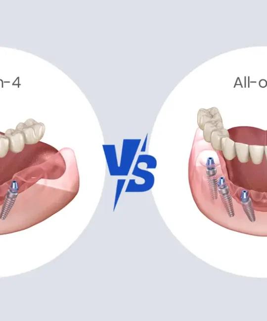 All-on-4 vs All-on-6 Implants: Which One Is Better for You in Michigan?