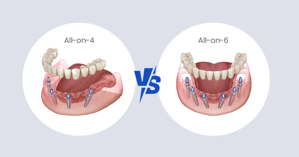 All-on-4 vs All-on-6 Implants: Which One Is Better for You in Michigan?