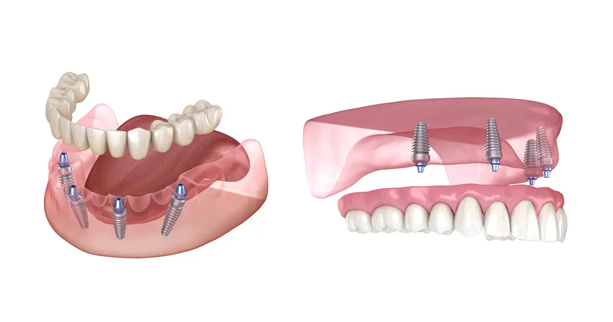 Dental Implant Procedure & Recovery