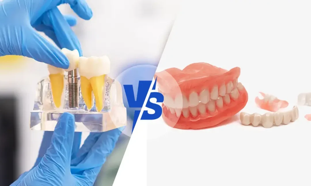 dental implants vs dentures