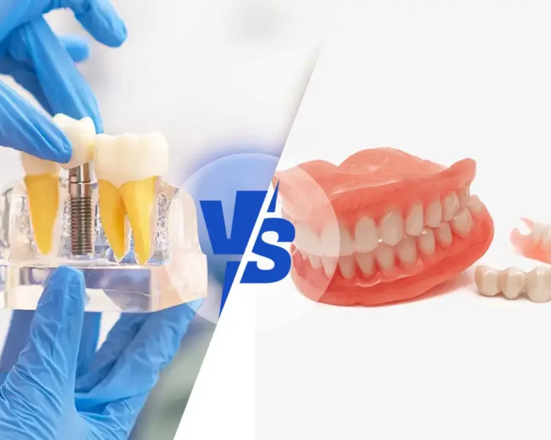 dental implants vs dentures